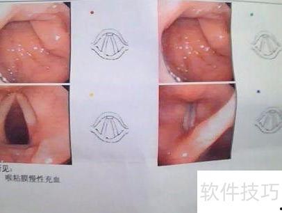 小孩喉镜视频,一次直观的医学之旅